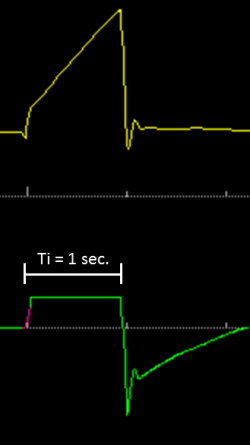 Tempo inspiratorio 1 sec